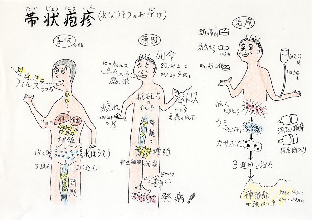 帯状疱疹